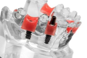diş implantları nedir İmplant Nedir
