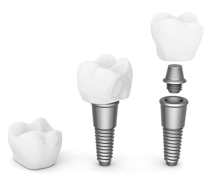 implant tedavisi implant tedavisi
