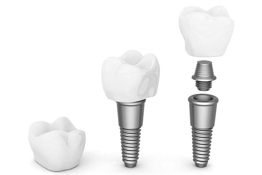 Diş implantı tedavisi