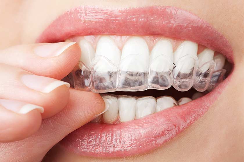 şeffaf braket invisalign ortodonti