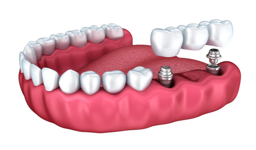 implant tedavisi