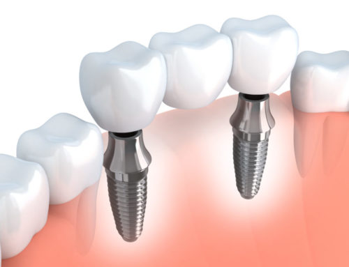 Four Things You Should Know About Dental Implants