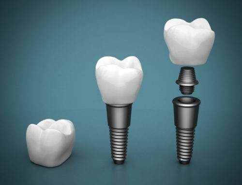 Requirements For Dental Implants