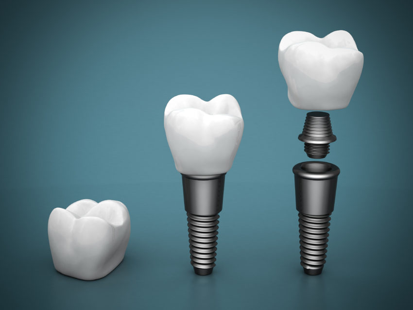 Diş implantlarının uygulanabilmesi için gereken şartlar