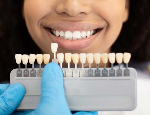 Hollywood Smile: Get Closer to Your Dreams with Smile Design