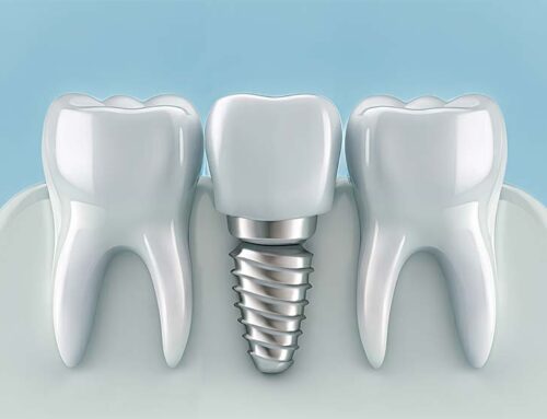 Is Dental Implant Treatment Painful? What to Expect During the Procedure