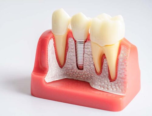 Is Dental Implant Possible with Bone Loss?