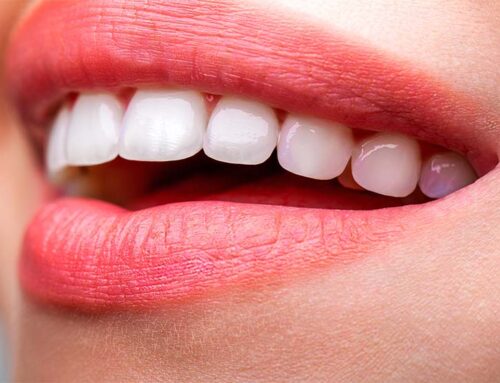 How Are Natural-Looking Veneers Designed?